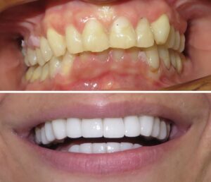complete-smile-makeover-before-after